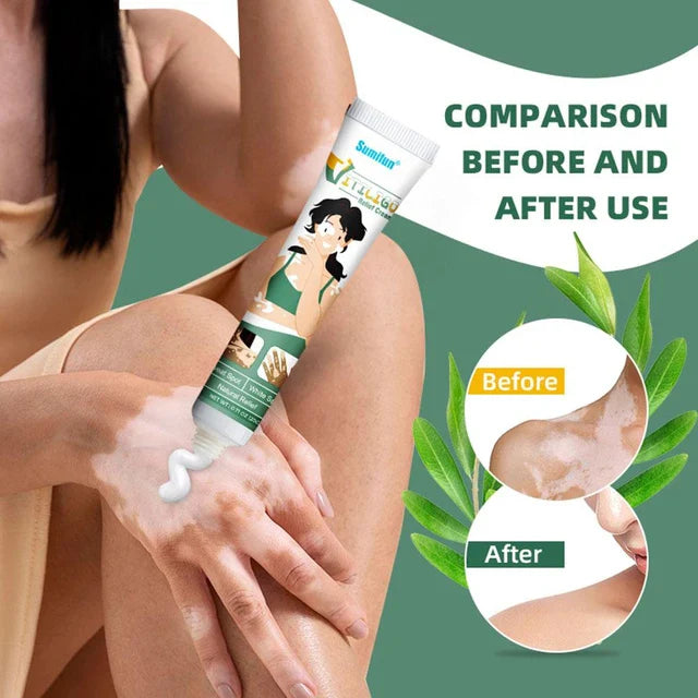 Herbal Extract - Vitiligo Ointment Remove Ringworm - White Spot Removal - Skin Vitiligo Eliminate Vitiligo Treatment Cream - White Spot Removal Cream Price in Pakistan