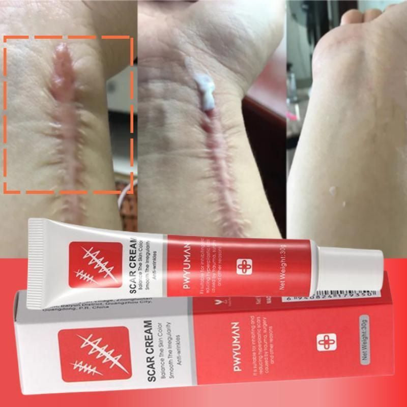 Effective Scar Removal Cream - Treatment Stretch Marks Burn Surgical Scar Ointment Acne Spot Repair Gel - Scar Removal Cream in Pakistan