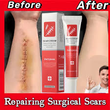 Effective Scar Removal Cream - Treatment Stretch Marks Burn Surgical Scar Ointment Acne Spot Repair Gel - Scar Removal Cream in Pakistan