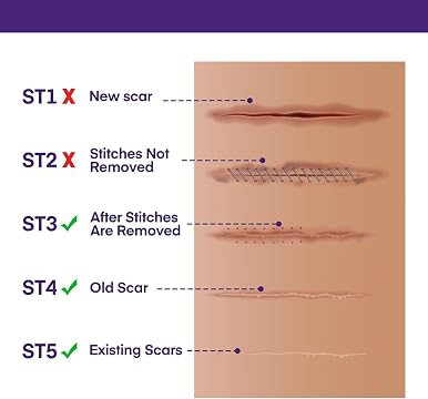 616Uji2e6QL._AC_CR0,0,0,0_SX480_SY360_ silicone scar removal gel before and after stretch mark results