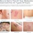 silicone scar removal gel before and after stretch mark results