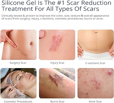 718ZKka8eML._AC_CR0,0,0,0_SX480_SY360_ silicone scar removal gel before and after stretch mark results