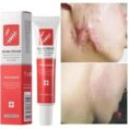 Before and after acne scar removal cream results Pakistan