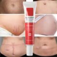 Before and after acne scar removal cream results Pakistan