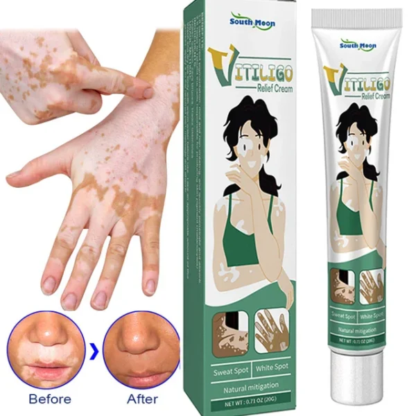 vitiligo cream Vitiligo Removal Cream in Pakistan – herbal skincare ointment by Medical Hub