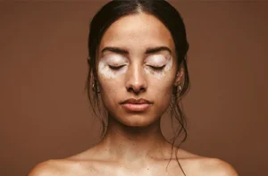 Vitiligo Treatment in Pakistan white spot skin patch close up