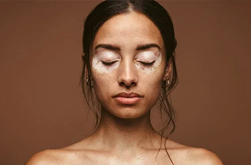 Vitiligo Treatment in Pakistan white spot skin patch close up